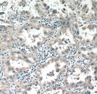 Immunohistochemistry: ALDH3B1 Antibody - BSA Free [NBP3-48185] - Immunohistochemistry of paraffin-embedded human lung cancer tissue slide using (ALDH3B1 Antibody) at dilution of 1:50