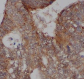 Immunohistochemistry: AKAP1 Antibody - BSA Free [NBP3-48191] - Immunohistochemistry of paraffin-embedded human colon cancer tissue slide using (AKAP1 Antibody) at dilution of 1:50