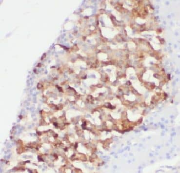 Immunohistochemistry: AGTRAP Antibody - BSA Free [NBP3-48197] - Immunohistochemical of paraffin-embedded human pancreas cancer using (AGTRAP antibody) at dilution of 1:10