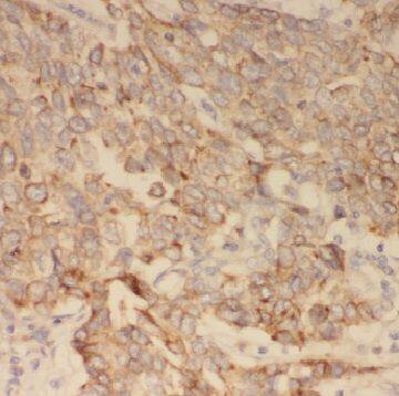Immunohistochemistry: CBCP3 Antibody - BSA Free [NBP3-48203] - Immunohistochemistry of paraffin-embedded human lung cancer tissue slide using (CBCP3 Antibody) at dilution of 1:50