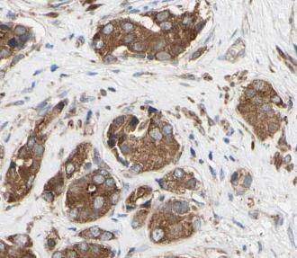 Immunohistochemistry: ACOT11 Antibody - BSA Free [NBP3-48235] - Immunohistochemistry of paraffin-embedded human prostate cancer using (ACOT11 antibody) at dilution of 1:100