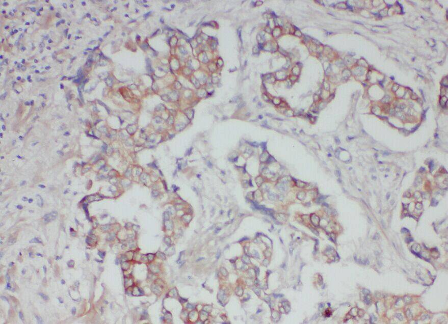 Immunohistochemistry: ABCB6 Antibody - BSA Free [NBP3-48251] - Immunohistochemistry of paraffin-embedded human breast cancer using (ABCB6 antibody) at dilution of 1:50