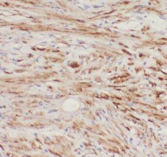 Immunohistochemistry: eIF4EBP2 Antibody - BSA Free [NBP3-48262] - Immunohistochemistry of paraffin-embedded human prostate cancer using (eIF4EBP2 antibody) at dilution of 1:100