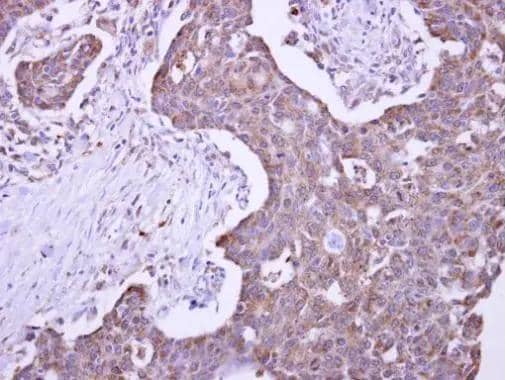 MLEC antibody detects KIAA0152 protein at cytosol on human colon carcinoma by immunohistochemical analysis. Sample: Paraffin-embedded colon carcinoma. MLEC antibody (NBP3-48443) dilution: 1:500.Antigen Retrieval: (EDTA based, pH 8.0) buffer, 15min 