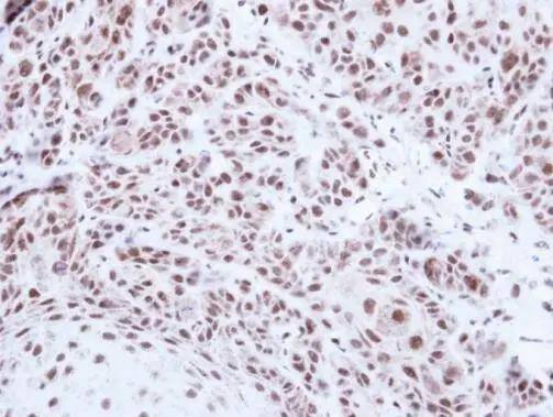 Immunohistochemical analysis of paraffin-embedded Cal27 xenograft , using PRPF39(NBP3-48451) antibody at 1:500 dilution. ^[^GTX]br>Antigen Retrieval: Citrate buffer, pH 6.0, 15 min 