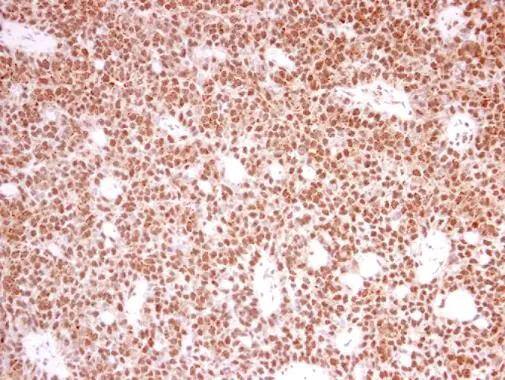 PRPF39 antibody [N2C1], Internal detects PRPF39 protein at nucleus in human lung carcinoma by immunohistochemical analysis. Sample: Paraffin-embedded human lung carcinoma. PRPF39 antibody [N2C1], Internal (NBP3-48451) diluted at 1:250. ^[^GTX]br>Antigen Retrieval: Citrate buffer, pH 6.0, 15 min 