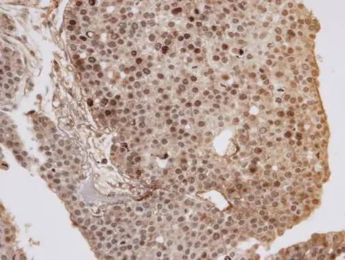 Immunohistochemical analysis of paraffin-embedded Huh7 xenograft, using GOLGA6B(NBP3-48474) antibody at 1:100 dilution. Antigen Retrieval: (EDTA based, pH 8.0) buffer, 15min 
