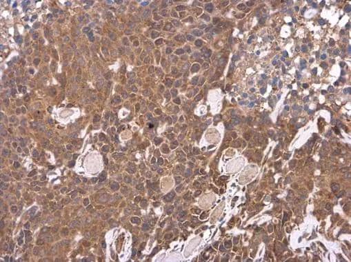 LIPC antibody [N1C1] detects LIPC protein at cytoplasm in Hep G2 xenograft by immunohistochemical analysis. Sample: Paraffin-embedded Hep G2 xenograft. LIPC antibody [N1C1] (NBP3-48490) diluted at 1:500. ^[^GTX]br>Antigen Retrieval: Citrate buffer, pH 6.0, 15 min 