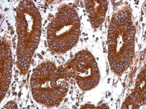 Immunohistochemical analysis of paraffin-embedded human colon carcinoma, using GANC(NBP3-48498) antibody at 1:500 dilution. ^[^GTX]br>Antigen Retrieval: Trilogy� (EDTA based, pH 8.0) buffer, 15min 