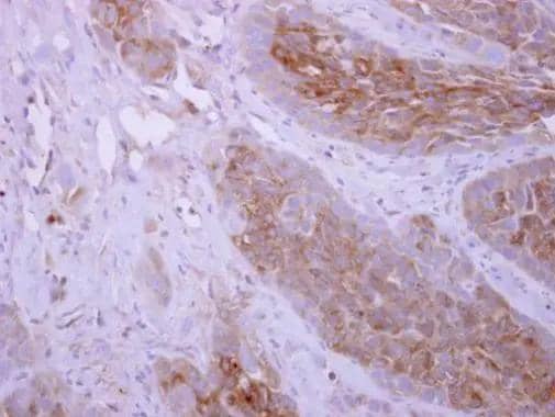 DPYD antibody [N1N2], N-term detects DPYD protein at cytoplasm on H358 xenograft by immunohistochemical analysis. Sample: Paraffin-embedded H358 xenograft. DPYD antibody [N1N2], N-term (NBP3-48502) dilution: 1:500. Antigen Retrieval: (EDTA based, pH 8.0) buffer, 15min 
