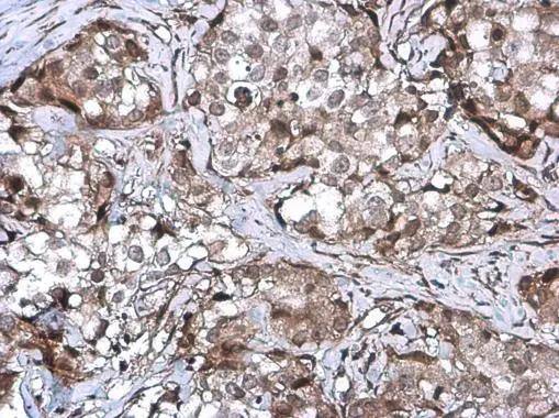 ZNF599 antibody detects ZNF599 protein at cytoplasm and nucleus by immunohistochemical analysis.Sample: Paraffin-embedded human breast carcinoma.ZNF599 stained by ZNF599 antibody (NBP3-48531) diluted at 1:500. ^[^GTX]br>Antigen Retrieval: Citrate buffer, pH 6.0, 15 min 