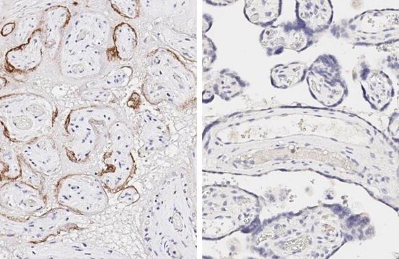 SARS Spike Protein antibody [1A9] (NBP3-48646) detects SARS-CoV-2 (COVID-19) spike protein by immunohistochemical analysis of SARS-CoV-2 infected human placenta (left) and normal human placenta (right).The IHC-P was performed by HISTOWIZ. 