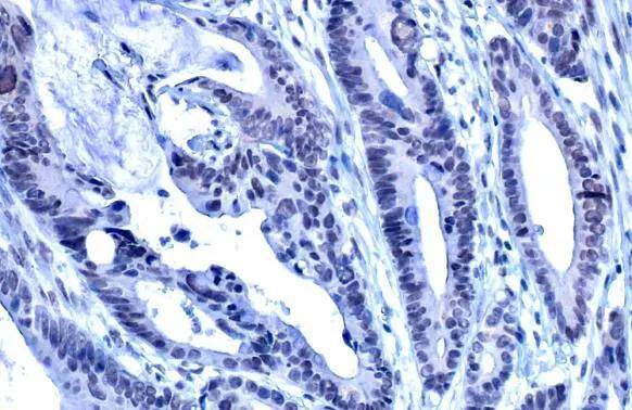 ADAR antibody [HL1789] detects ADAR protein at cytoplasm and nucleus by immunohistochemical analysis.Sample: Paraffin-embedded human colon.ADAR stained by ADAR antibody [HL1789] (NBP3-48664) diluted at 1:100.Antigen Retrieval: Citrate buffer, pH 6.0, 15 min 