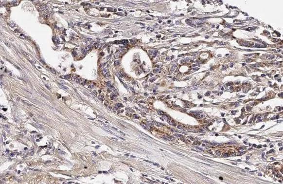 <b>Genetic Strategies Validation. </b>mtTFA antibody [HL2012] detects mtTFA protein at mitochondria by immunohistochemical analysis.Sample: Paraffin-embedded human colon cancer.mtTFA stained by mtTFA antibody [HL2012] (NBP3-48669) diluted at 1:100.Antigen Retrieval: Citrate buffer, pH 6.0, 15 min 