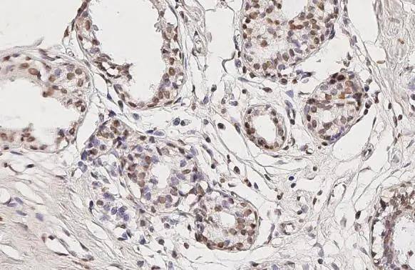 TET3 antibody [HL2463] detects TET3 protein by immunohistochemical analysis.Sample: Paraffin-embedded human breast carcinoma.TET3 stained by TET3 antibody [HL2463] (NBP3-48685) diluted at 1:100.Antigen Retrieval: Citrate buffer, pH 6.0, 15 min 