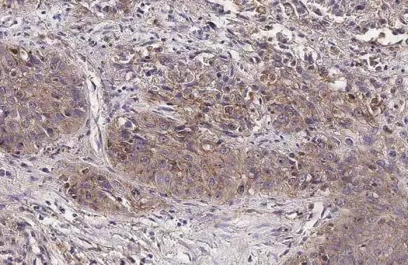ADAMTSL2 antibody [HL2616] detects secreted ADAMTSL2 protein by immunohistochemical analysis.Sample: Paraffin-embedded human lung cancer.ADAMTSL2 stained by ADAMTSL2 antibody [HL2616] (NBP3-48706) diluted at 1:100.Antigen Retrieval: Citrate buffer, pH 6.0, 15 min 