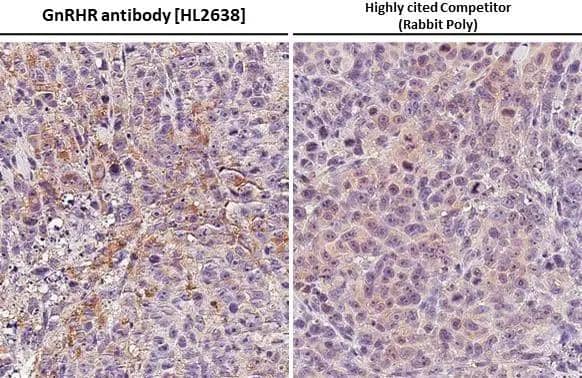 GnRHR antibody [HL2638] detects GnRHR protein at cell membrane by immunohistochemical analysis.Sample: Paraffin-embedded PC-3 xenograft.GnRHR stained by GnRHR antibody [HL2638] (NBP3-48712) diluted at 1:200 and competitor's antibody (19950-1-AP) diluted at 1:200.Antigen Retrieval: Citrate buffer, pH 6.0, 15 min*Competitor's antibody is not affiliated with and does not endorse this product. 
