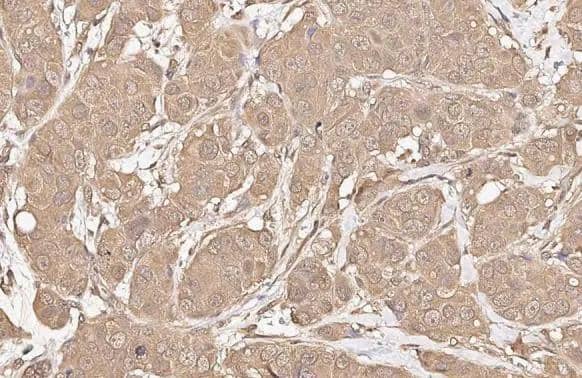 AKT antibody [HL2915] detects AKT protein by immunohistochemical analysis.Sample: Paraffin-embedded human breast carcinoma.AKT stained by AKT antibody [HL2915] (NBP3-48751) diluted at 1:100.Antigen Retrieval: Citrate buffer, pH 6.0, 15 min 