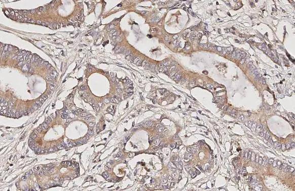 Somatostatin R4/SSTR4 antibody [HL2933] detects Somatostatin R4/SSTR4 protein by immunohistochemical analysis.Sample: Paraffin-embedded human colon cancer.Somatostatin R4/SSTR4 stained by Somatostatin R4/SSTR4 antibody [HL2933] (NBP3-48752) diluted at 1:100.Antigen Retrieval: Citrate buffer, pH 6.0, 15 min 