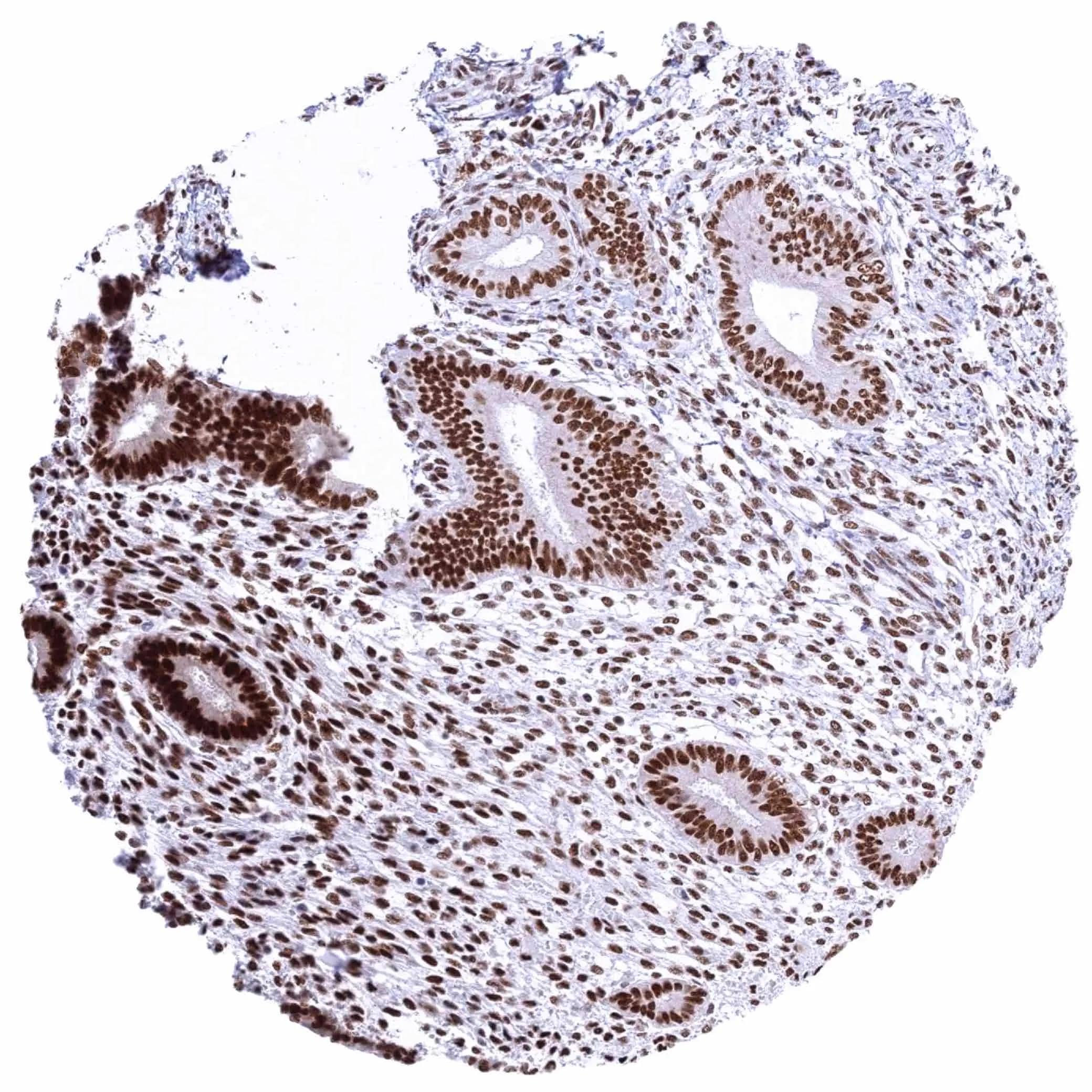 IHC-P analysis of human endometrium (proliferation) tissue using KDM6A antibody (HMV311).Strong nuclear KDM6A staining of epithelial and stromal cells.