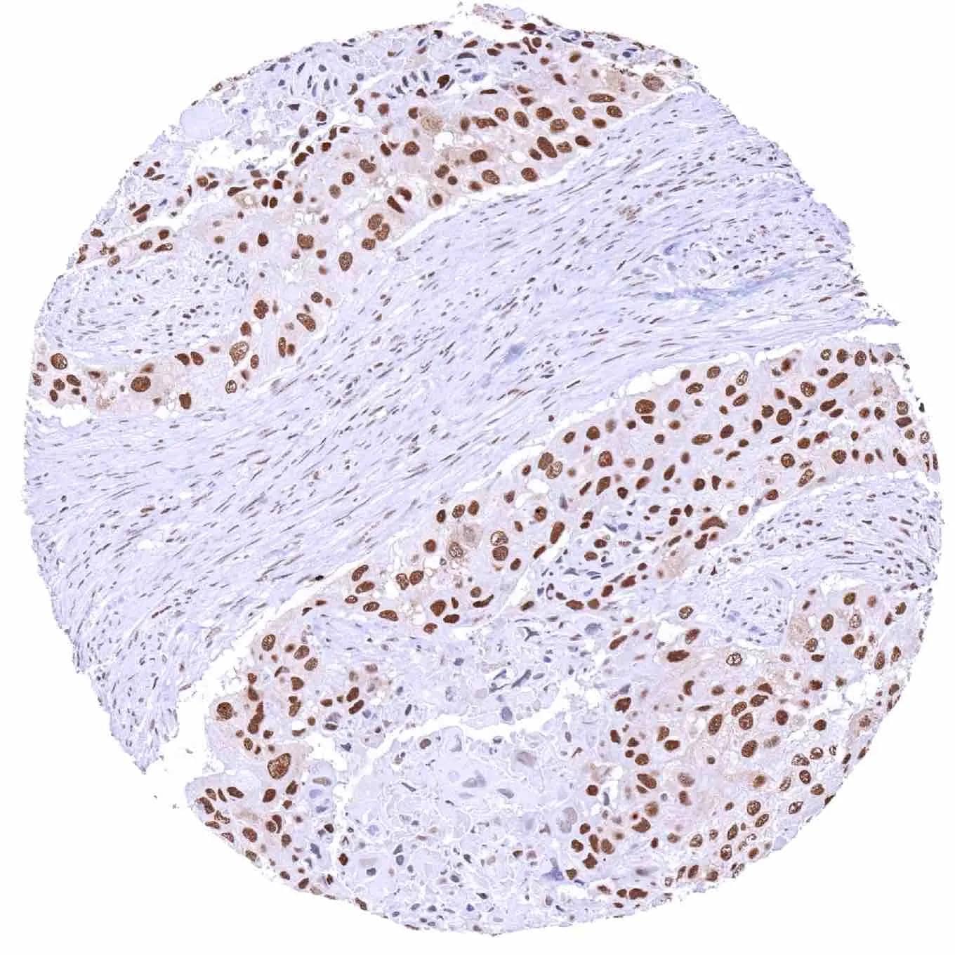 IHC-P analysis of human squamous cell carcinoma (SCC) from penile tissue using KDM6A antibody (HMV311).Squamous cell carcinoma with strong KDM6A staining of tumor cells.