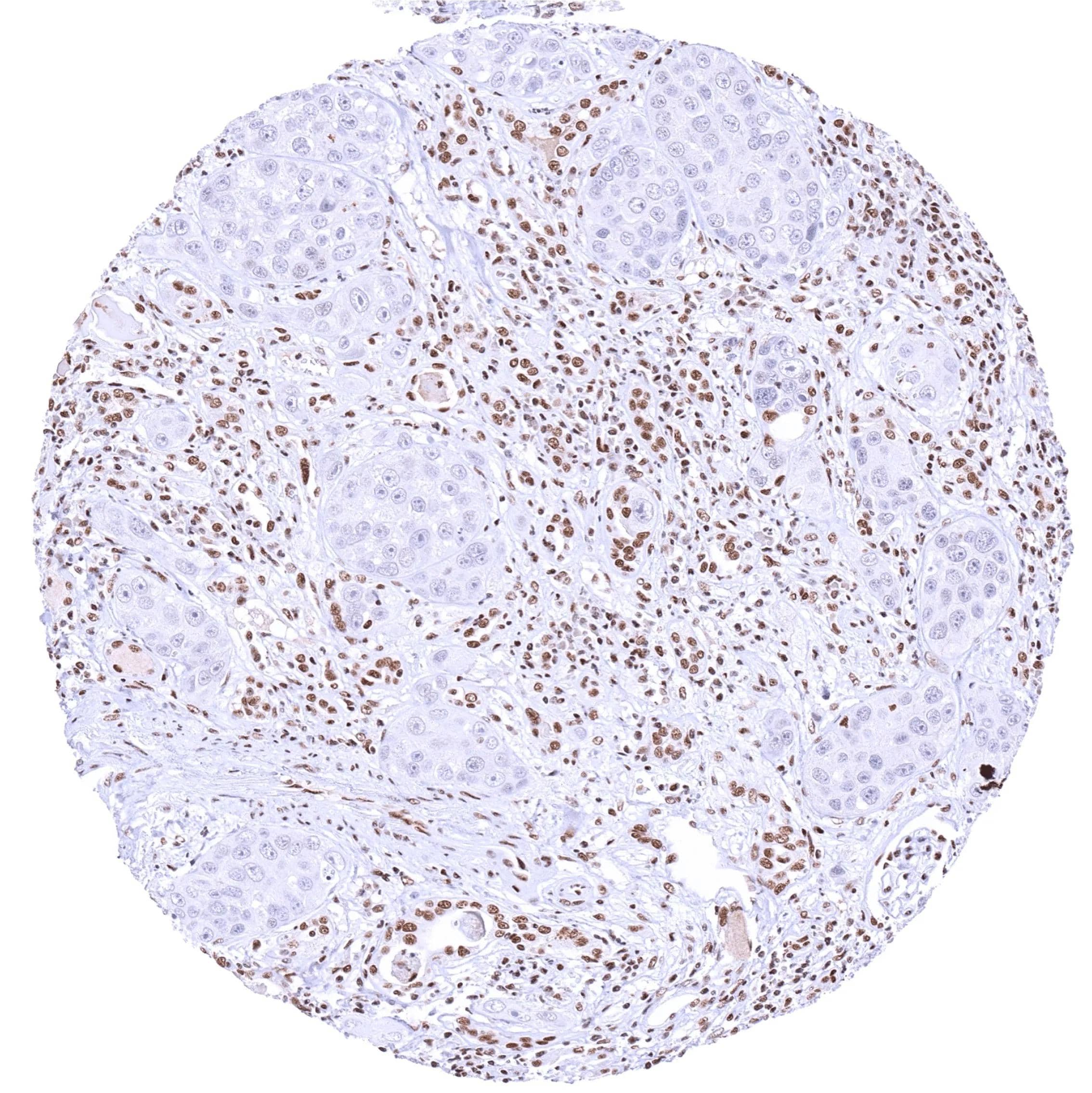 IHC-P analysis of human invasive urothelial carcinoma from kidney tissue using KDM6A antibody (HMV311).A complete absence of KDM6 staining in tumor cells