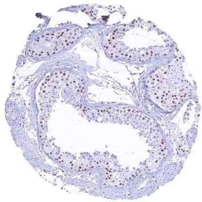 IHC-P analysis of human testis tissue using KDM6A antibody (HMV311).A moderate to A strong nuclear KDM6A staining of Sertoli cells. KDM6A staining is weak in spermatogonia and virtually absent in more mature cells of spermatogenesis.