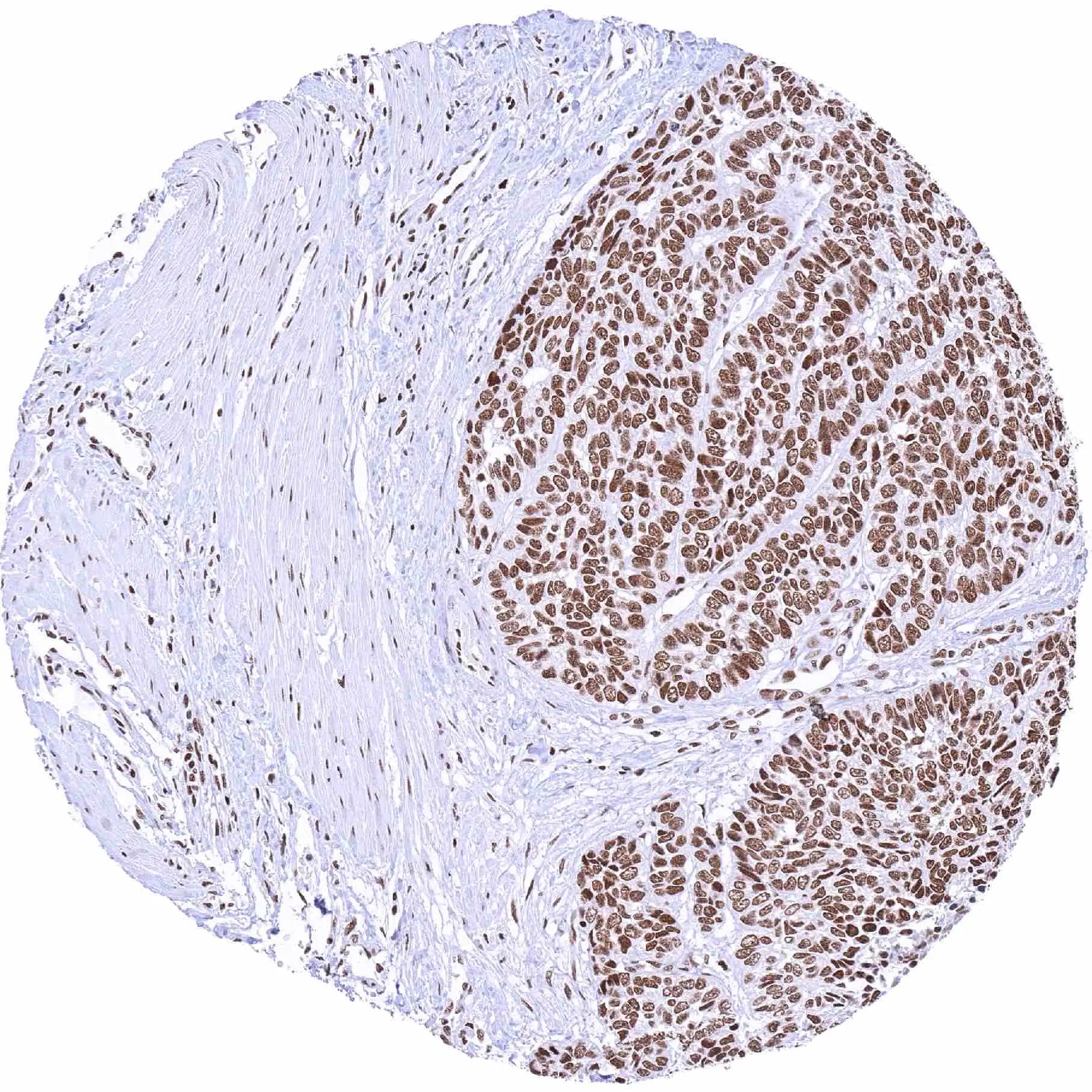 IHC-P analysis of human anal canal squamous cell carcinoma (SCC) tissue using SMARCA2 antibody (HMV337)Squamous cell carcinoma with strong SMARCA2 immunostaining of tumor cells.