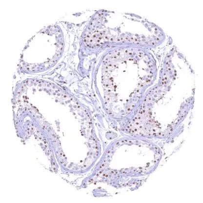 IHC-P analysis of human testis tissue using SMARCA2 antibody (HMV337).A distinct nuclear SMARCA2 staining in all intratubular cells except Sertoli cells.