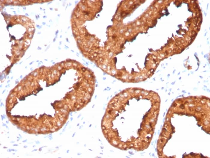 Formalin-fixed, paraffin-embedded human prostate carcinoma stained with Kallikrein 3/PSA Antibody (KLK3/4551R).