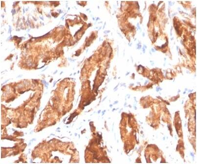 Formalin-fixed, paraffin-embedded human prostate carcinoma stained with Kallikrein 3/PSA Antibody (KLK3/4602R).