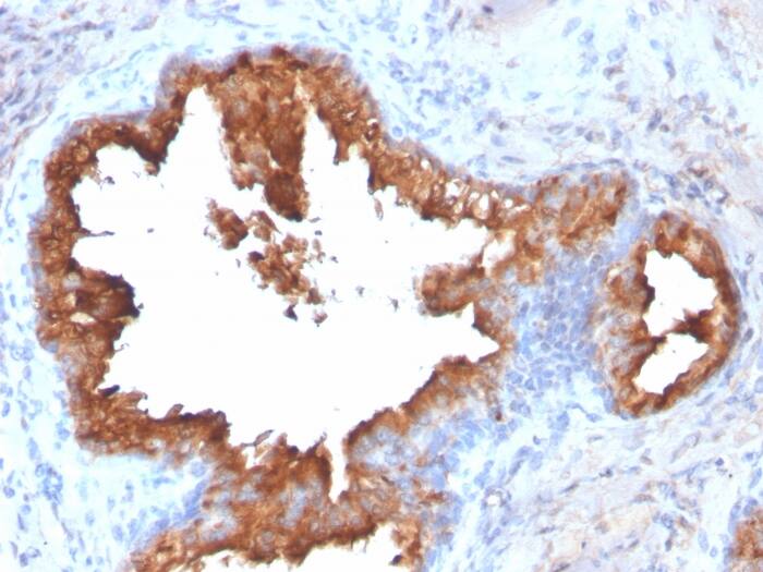 Formalin-fixed, paraffin-embedded human Prostate Carcinoma stained with Kallikrein 3/PSA Antibody (KLK3/2871R).