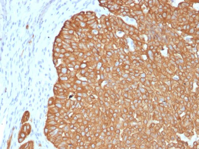 Formalin-fixed, paraffin-embedded human basal cell carcinoma stained with Cytokeratin 5 Antibody (KRT5/4245R).