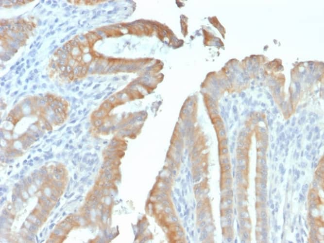 Formalin-fixed, paraffin-embedded human Colon Carcinoma stained with Cytokeratin 19 Antibody (rKRT19/799).