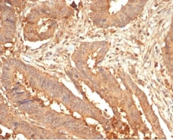 Formalin-fixed, paraffin-embedded human colon stained with Galectin-3 Antibody (LGALS3/7036R). HIER: Tris/EDTA, pH9.0, 45min. 2�C: HRP-polymer, 30min. DAB, 5min.
