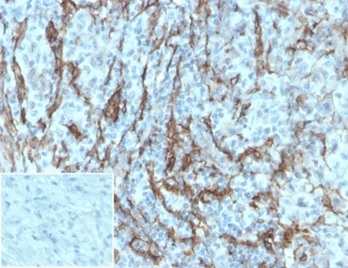 Formalin-fixed, paraffin-embedded human melanoma stained with NGFR/TNFRSF16/p75NTR Antibody (NGFR/1997R). Inset: PBS instead of primary antibody; secondary only negative control.