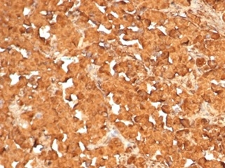 Formalin-fixed, paraffin-embedded human pituitary tumor stained with ACTH Antibody (rCLIP4278). HIER: Tris/EDTA, pH9.0, 45min. 2�C: HRP-polymer, 30min. DAB, 5min.