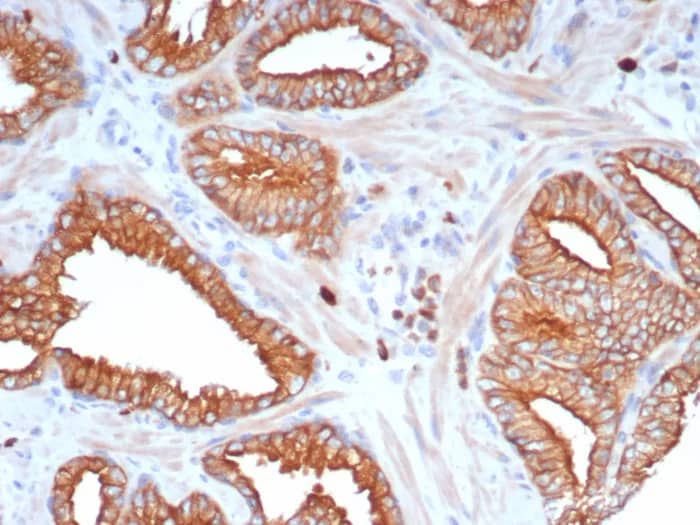 Formalin-fixed, paraffin-embedded human prostate stained with L1TD1 Antibody (L1TD1/7941). HIER: Tris/EDTA, pH9.0, 45min. 2�C: HRP-polymer, 30min. DAB, 5min.