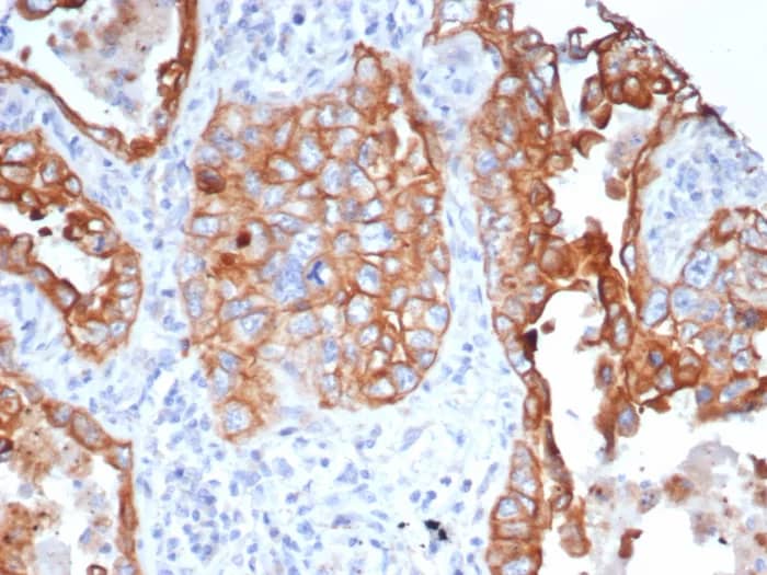 Formalin-fixed, paraffin-embedded human lung stained with L1TD1 Antibody (L1TD1/7941). HIER: Tris/EDTA, pH9.0, 45min. 2�C: HRP-polymer, 30min. DAB, 5min.