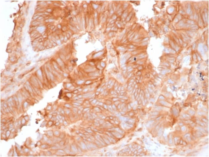 Formalin-fixed, paraffin-embedded human Colon Carcinoma stained with beta 2-Microglobulin Antibody (rB2M/961).