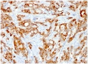 Formalin-fixed, paraffin-embedded human Lung Carcinoma stained with beta 2-Microglobulin Antibody (rB2M/961).