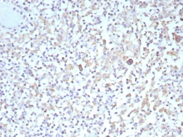 Formalin-fixed, paraffin-embedded human Hodgkin's lymphoma stained with bcl-x Antibody (BCL2L1/9221R). HIER: Tris/EDTA, pH9.0, 45min. 2�C: HRP-polymer, 30min. DAB, 5min.