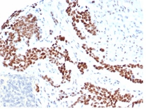 Formalin-fixed, paraffin-embedded human ovarian carcinoma stained with WT1 Antibody (rWT1/6908). Inset: PBS instead of primary antibody; secondary only negative control.