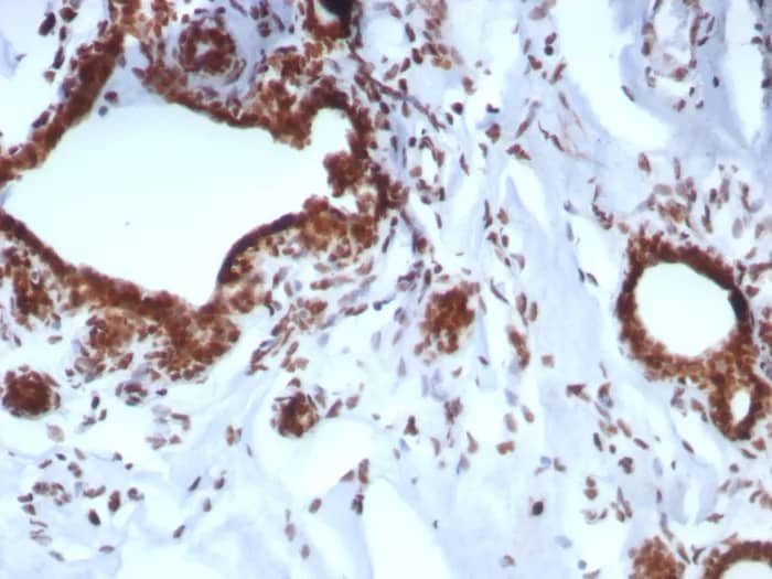 Formalin-fixed, paraffin-embedded human breast carcinoma stained with BAP1 Antibody (BAP1/8959R). HIER: Tris/EDTA, pH9.0, 45min. 2�C: HRP-polymer, 30min. DAB, 5min.