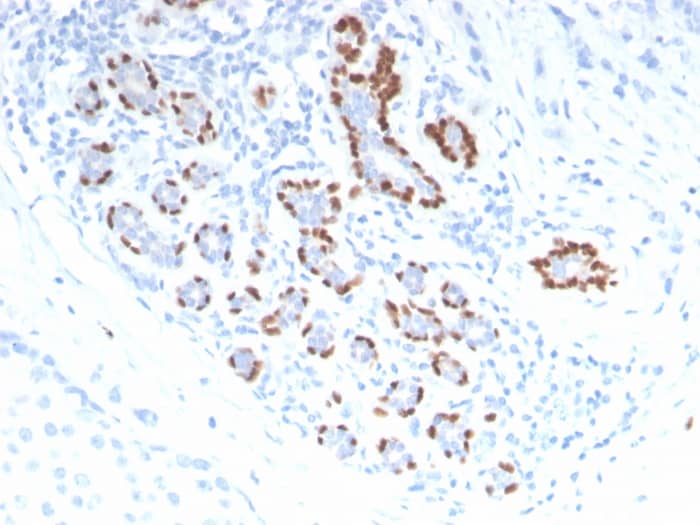 Formalin-fixed, paraffin-embedded human Breast Carcinoma stained with p40/deltaNp63 Antibody.