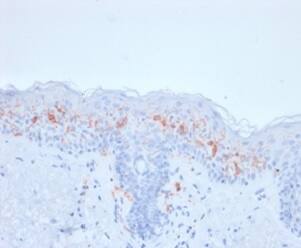 Formalin-fixed, paraffin-embedded human skin stained with CD1a Antibody (rC1A/711).