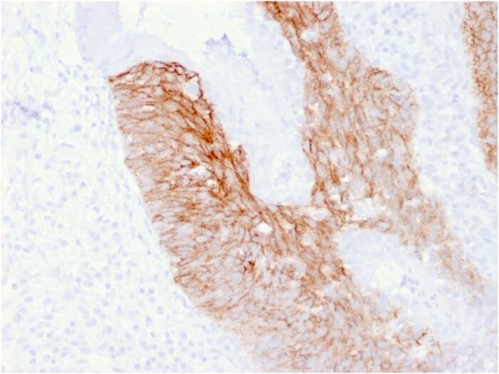 Formalin-fixed, paraffin-embedded human Cervix Carcinoma stained with CD44, variant 6 Antibody (CD44V6/2496).