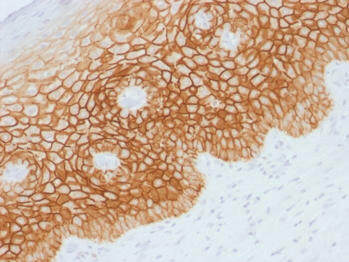 Formalin-fixed, paraffin-embedded human Cervical Squamous Cell Carcinoma stained with CD44, variant 4 Antibody.