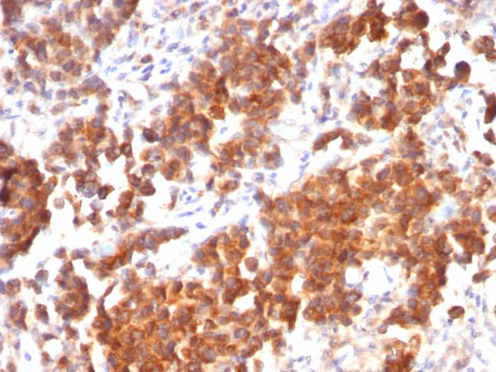 Formalin-fixed, paraffin-embedded human Parathyroid Mass stained with TL1A/TNFSF15 Antibody (rVEGI/1283).