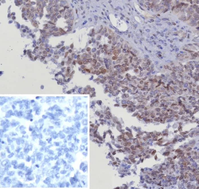 Formalin-fixed, paraffin-embedded human serous ovarian cancer stained with CDK4 Antibody (CDK4/8351R). Inset: PBS instead of primary antibody; secondary only negative control.